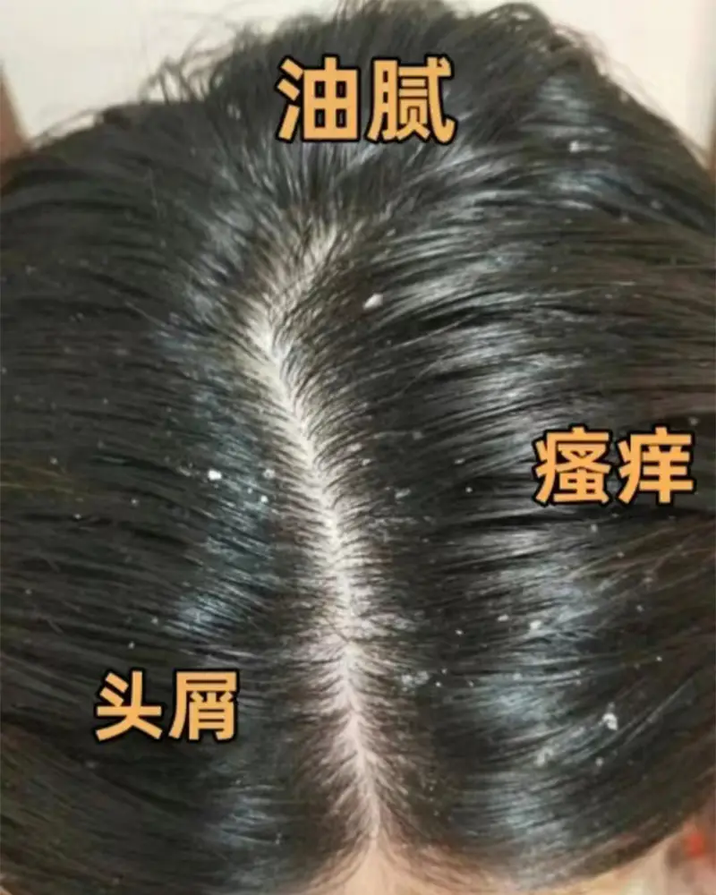 頭皮癢哪個洗發水好？洗發水獲FDA去屑認證